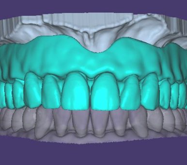 Complet-haut-digiprotheses Modelisation 3d d'un complet du haut enocclusion